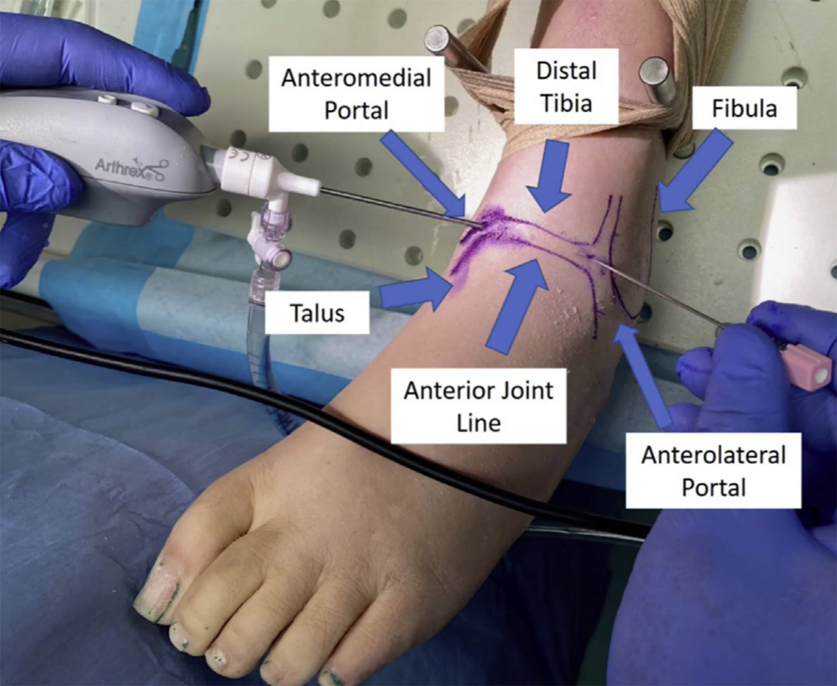 Ankle Arthroscopy