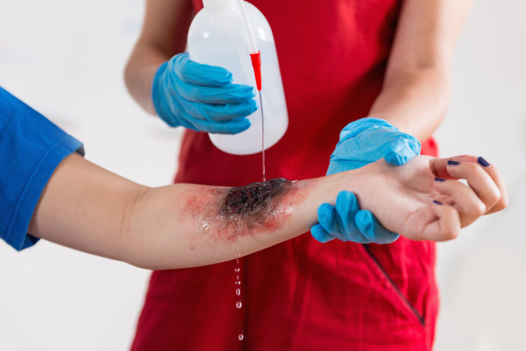 Burn injuries and contractures 1