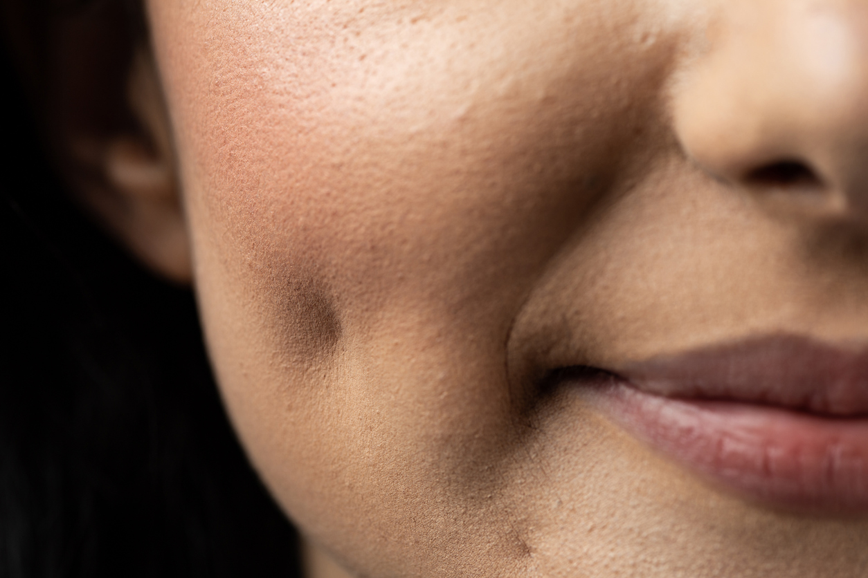 Dimple creation