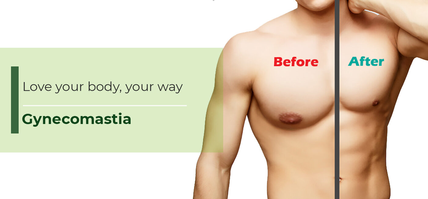 Gynecomastia