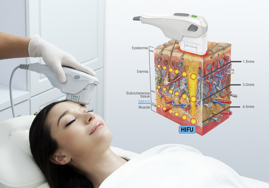 HIFU Treatment