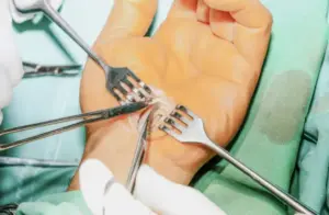 Hand surgery