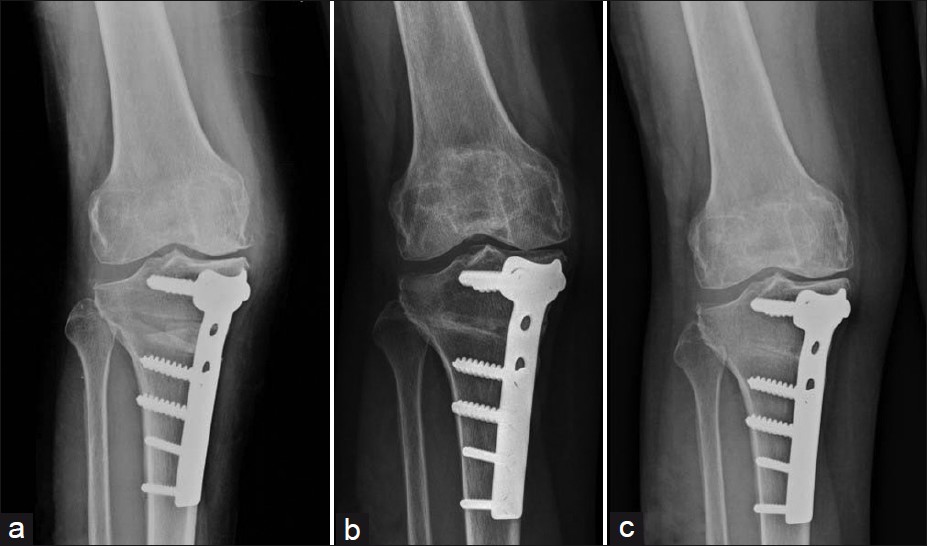 High Tibial Osteotomy (HTO)