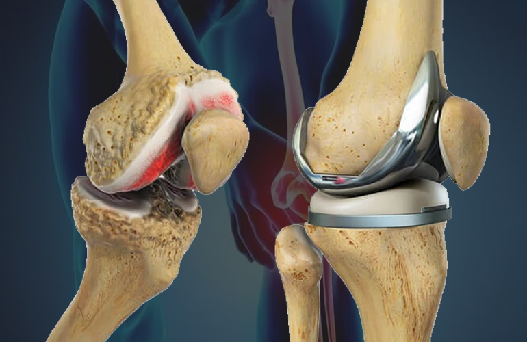 Joint Replacement Surgery