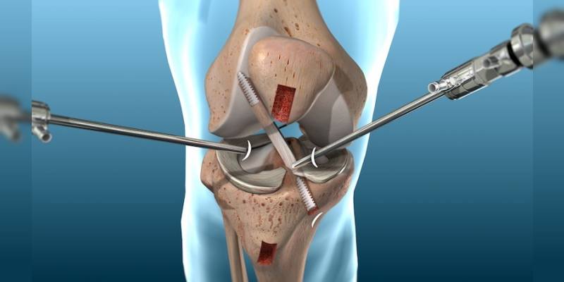 Knee Arthoscopy