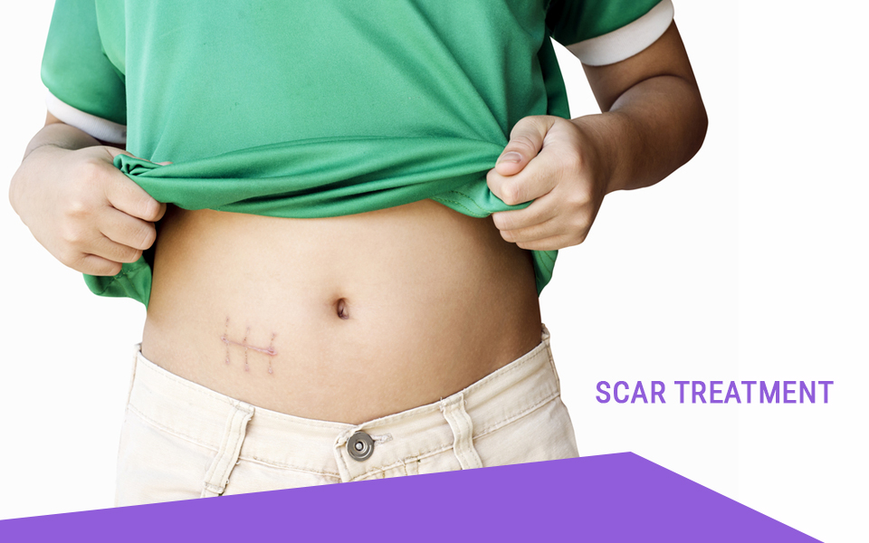 Scat treaatment