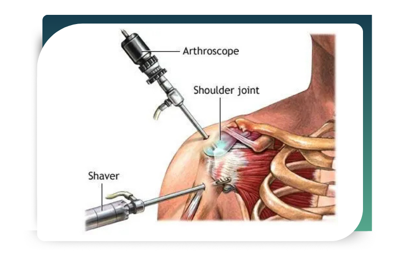 Shoulder Arthroscopy