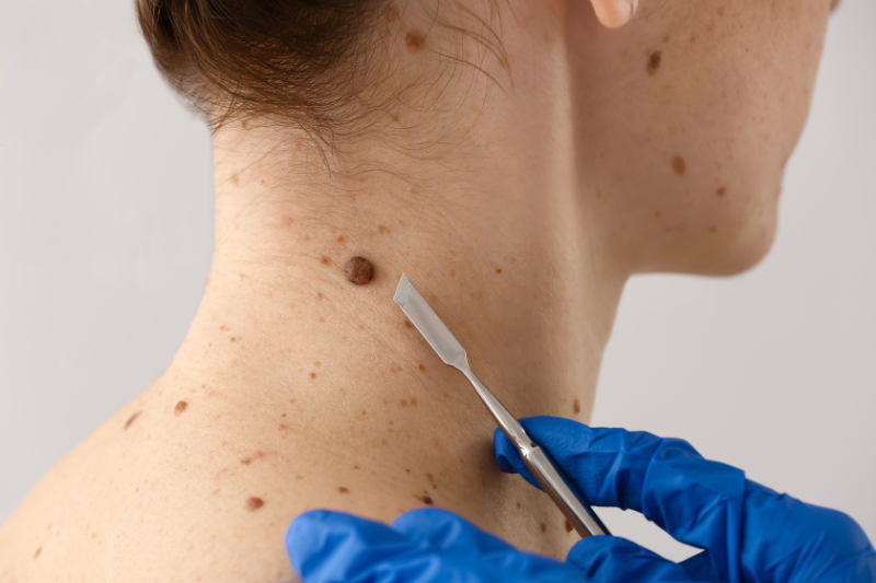 Skin Cancer