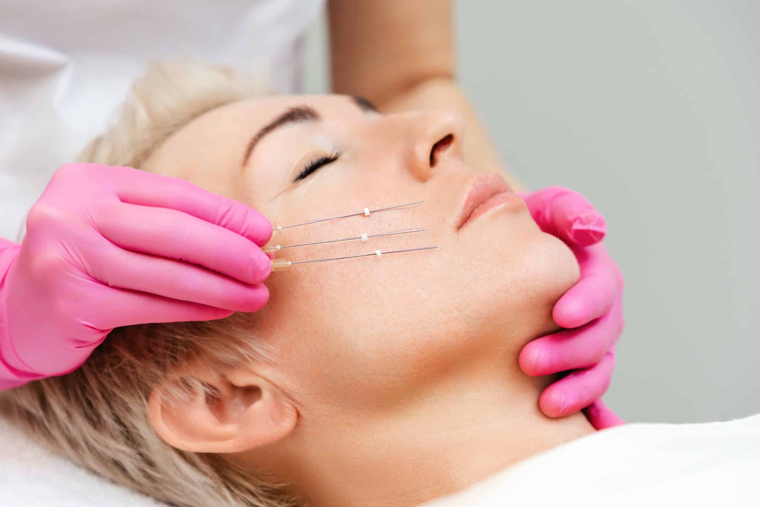 Thread lift treatment