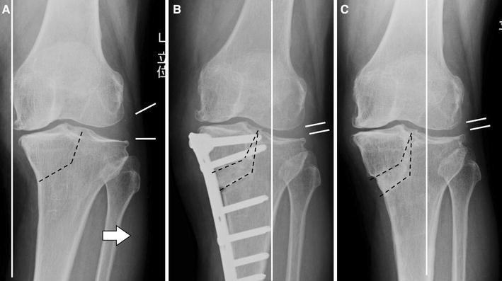 Tibial Condylar Valgus Osteotomy (TCVO)