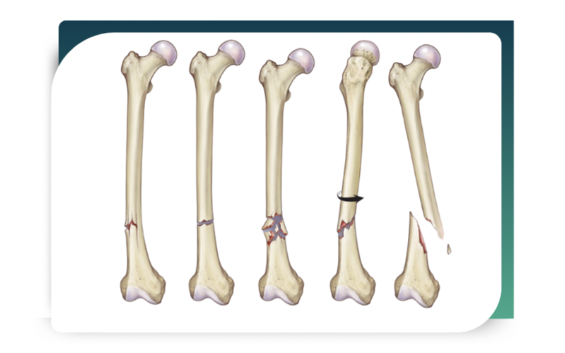 bones