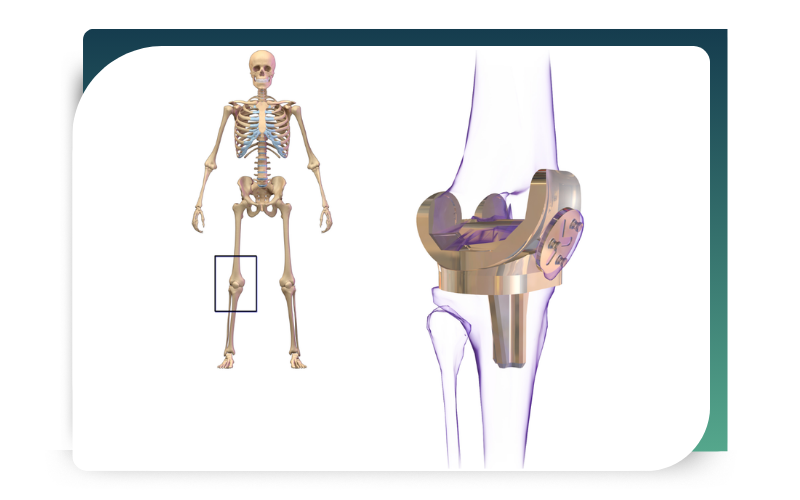 knee surgery
