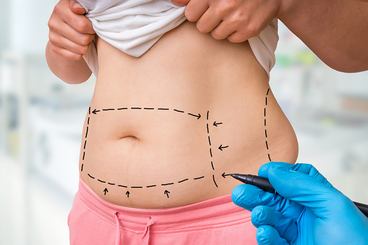 liposuction