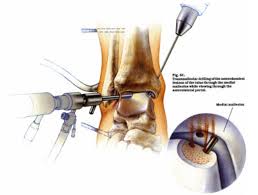 Ankle Arthroscopy Clinic In Nagpur