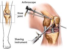 Arthroscopy Centre In Nagpur