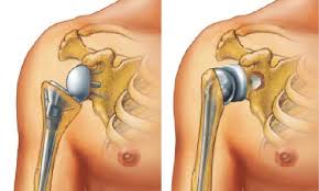 Best Shoulder Surgeon In Raisen