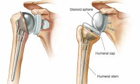 Best Shoulder Surgeon In Rewa