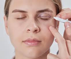 Blepharoplasty in Nagpur