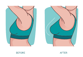 Breast Augmentation In Sagar