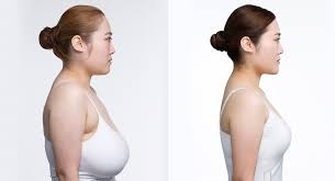 Breast Reduction Surgery in Nagpur