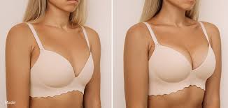 Breast augmentation in Ratlam