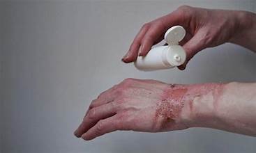 Burn Scar Treatment