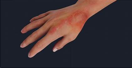 Burn injury reconstruction