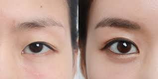 Cosmetic Surgery in Koriya