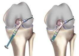 Cruciate Ligament Repair And Reconstruction In Nagpur
