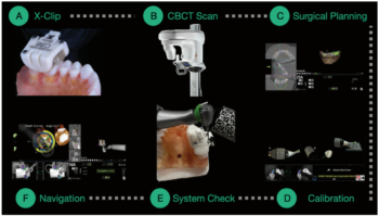 Custom surgical planning