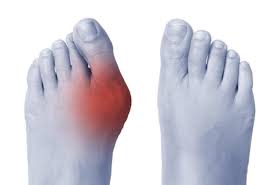 Foot Deformity Correction in Nagpur