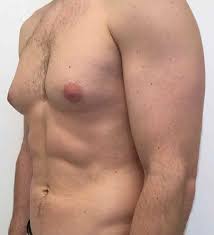 Gynecomastia Surgery in Nagpur