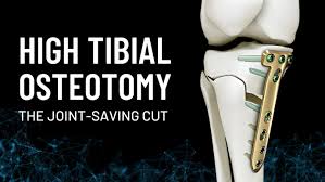High Tibial Osteotomy (HTO) in Nagpur