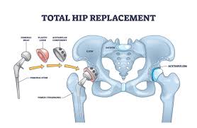 Hip Replacement Surgery In Burhanpur