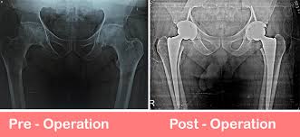 Hip Replacement Surgery in Bemetara