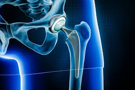Hip Replacement Surgery in Bijapur