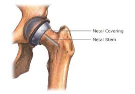 Hip Replacement Surgery in Durg