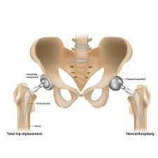 Hip Replacement Surgery in Gaurela-Pendra-Marwahi