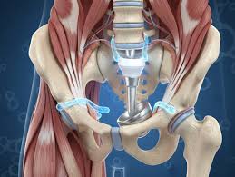 Hip Replacement Surgery in Mahasamund