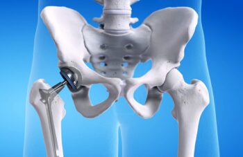 Hip replacement surgery in nagpur