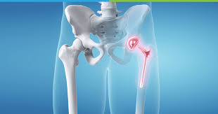 Hip replacement surgery in Bhopal
