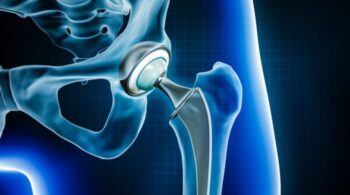 Hip replacement surgery in wardha