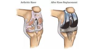 Joint Replacement Surgeon In Nagpur