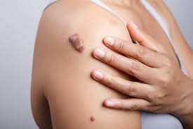 Keloid Treatment in Nagpur