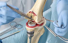 Knee Replacement Surgeon In Nagpur
