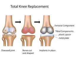 Knee Replacement Surgery In Sagar