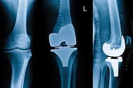 Knee Replacement Surgery in Bastar