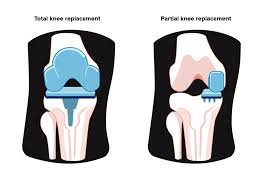 Knee Replacement Surgery in Janjgir-Champa