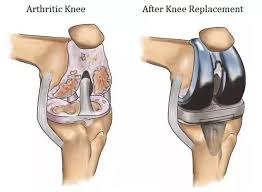 Knee Replacement Surgery in Koriya