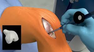 Knee Replacement Surgery in Mungeli
